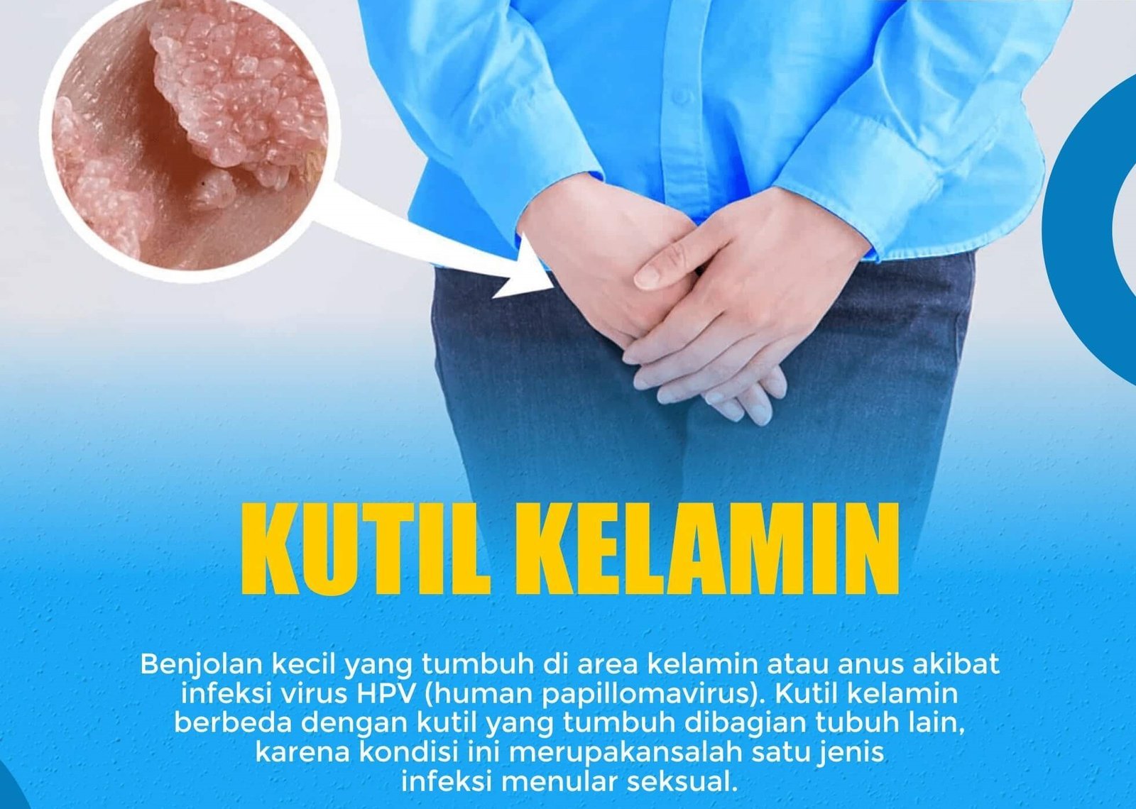 Kutil Kelamin Klinik Penyakit Menular Seksual