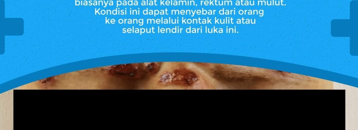 Sifilis Klinik Penyakit Menular Seksual