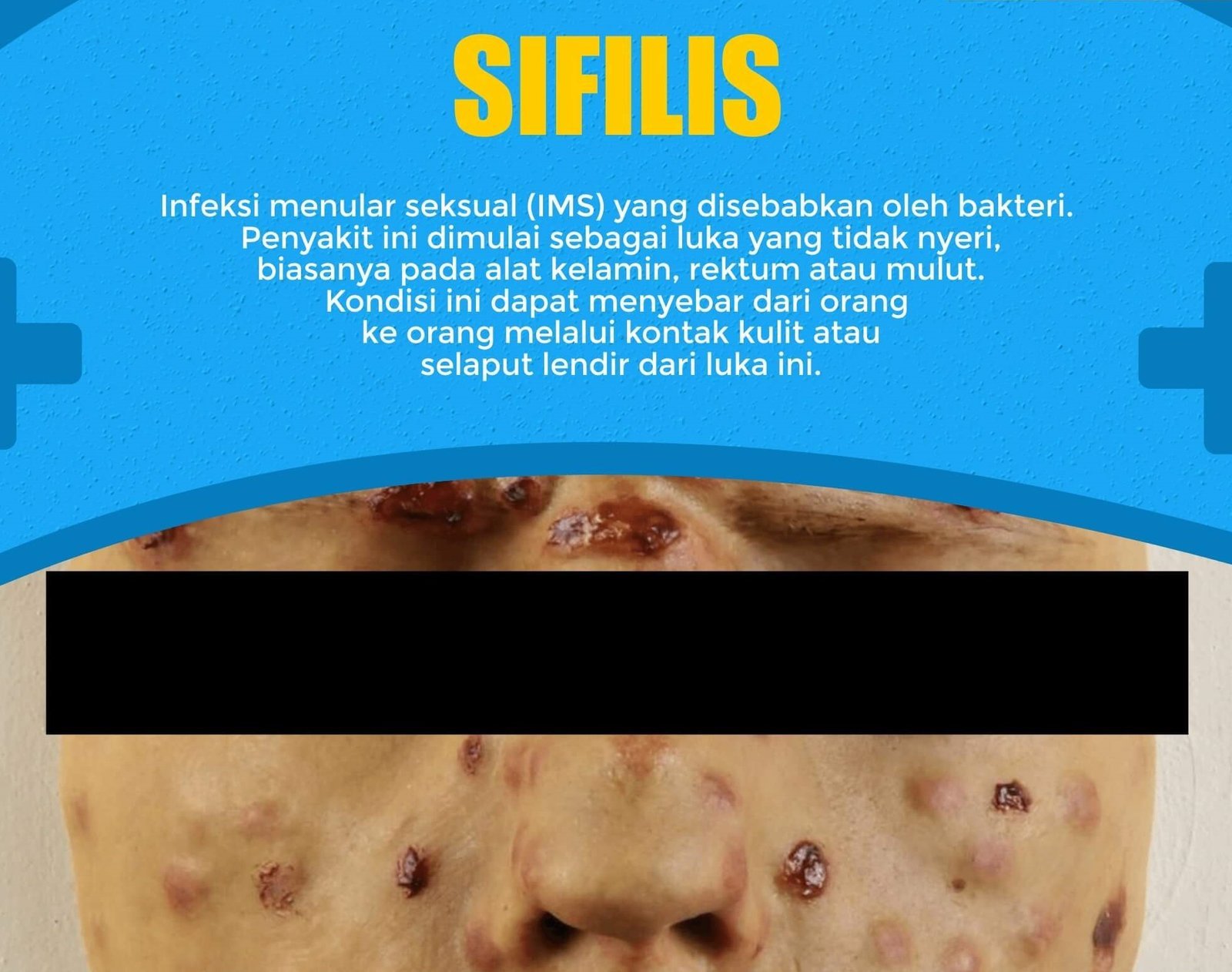 Sifilis Klinik Penyakit Menular Seksual